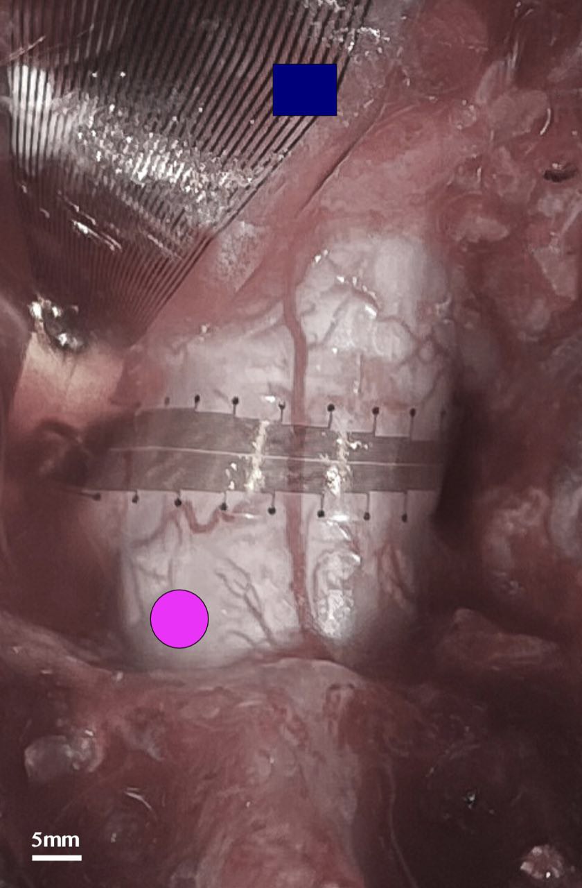 i360 Anatomical Implantation