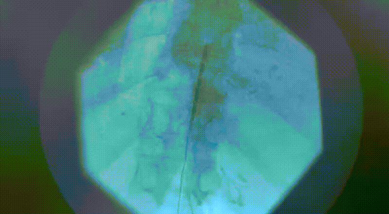 Electrode Expansion Sequence